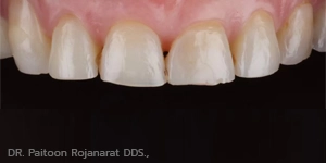 ทำฟันวีเนียร์ รีวิว