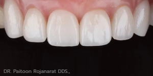 ลักษณะ ฟันสวย