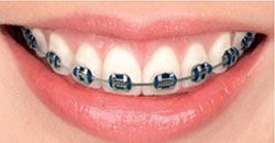 orthodontic metal braces