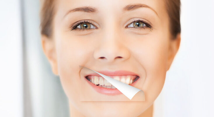 tooth whitening in thailand