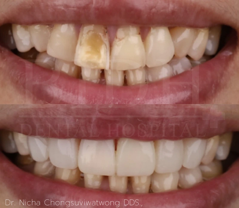 case ceramic veneer