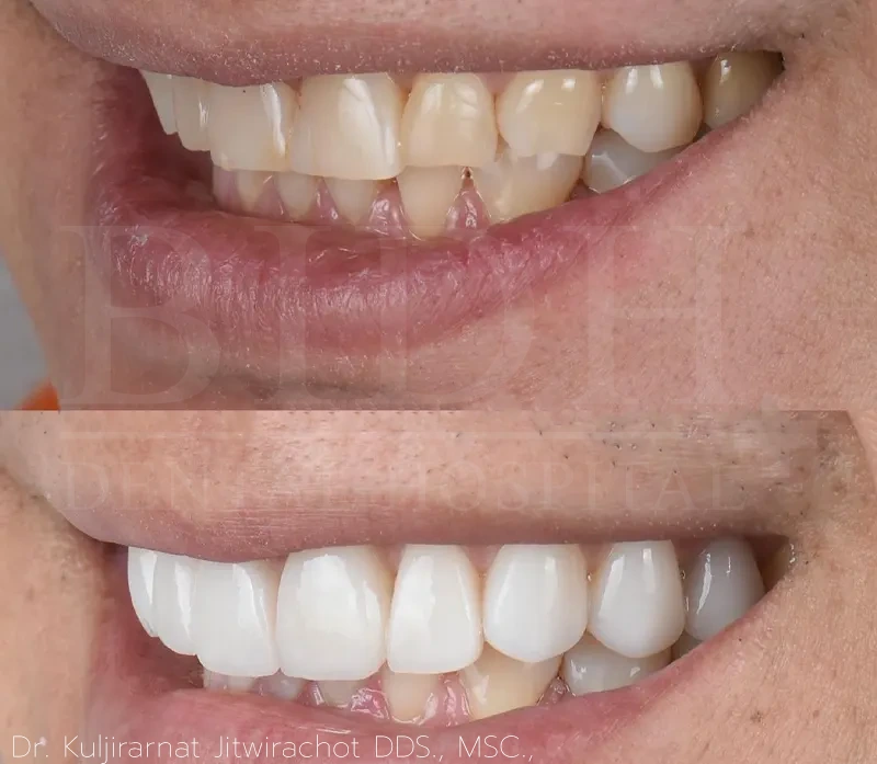 case ceramic veneer